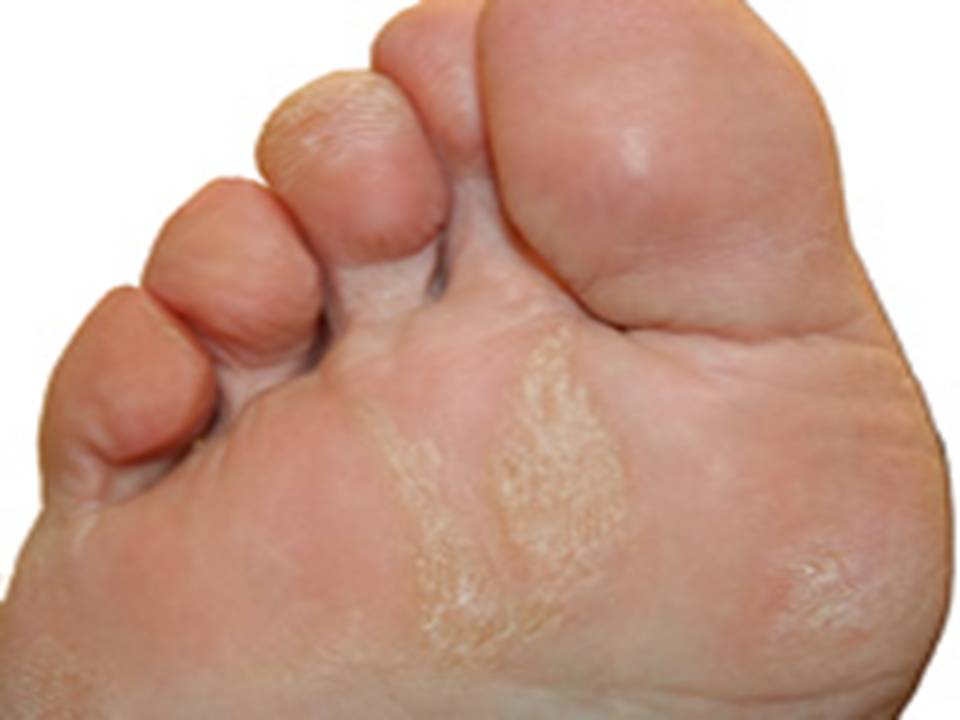Hard skin on bottom of foot