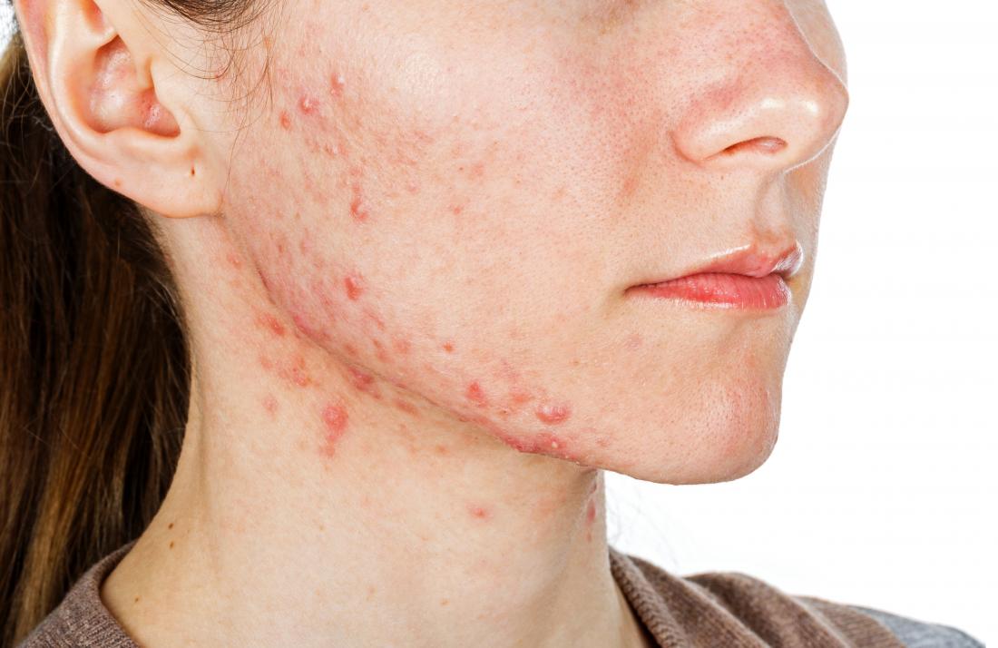 Dino reccomend Is facial acne related to stds