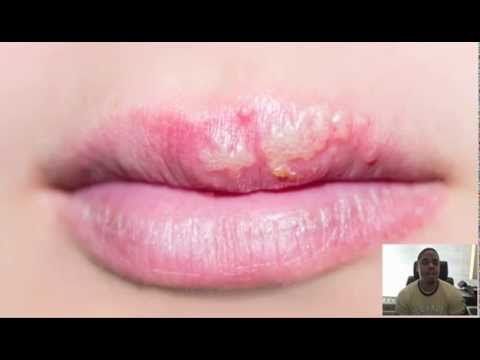 best of Herpes someone with with Oral sex