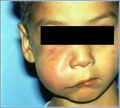 best of Cellulitis Right facial