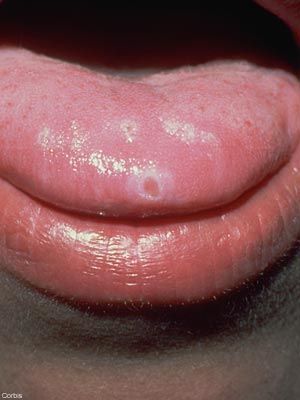 best of Mouth Scabies