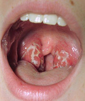 best of Mouth Scabies