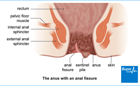 best of Fissures around anus Skin