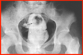 Meatball reccomend Xrays of anal penetration