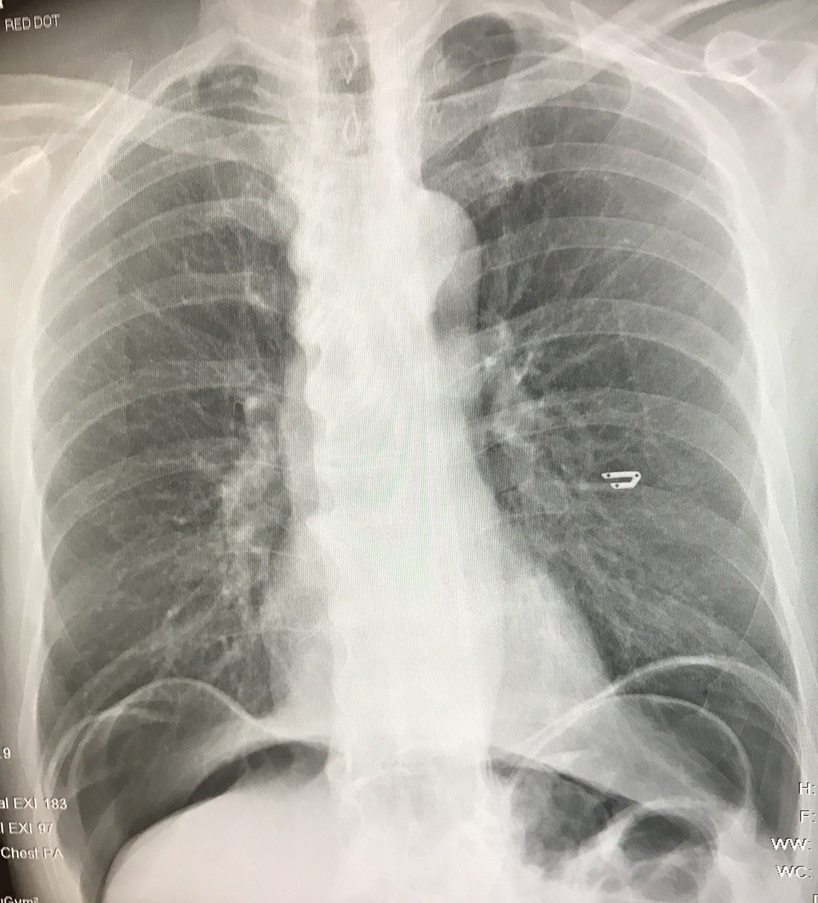 X-ray of cock in throat